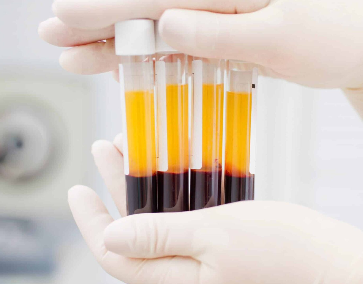 Platelet Rich Plasma (PRP) & Platelet Rich Fibrin (PRF)